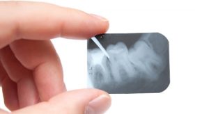 obturations-dentaires